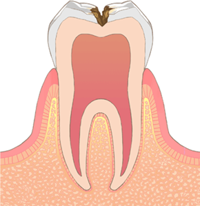 むし歯イメージ